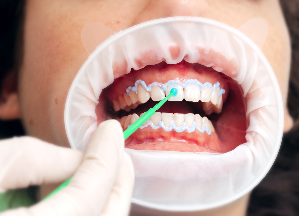 tooth whitening procedure