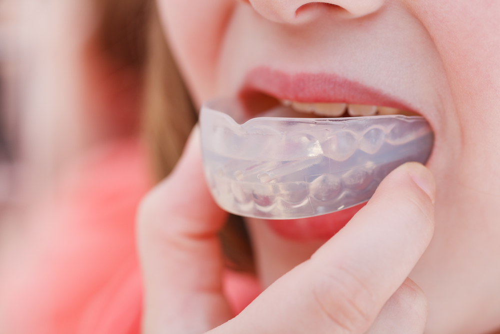 Mouthguard PROs and CONs