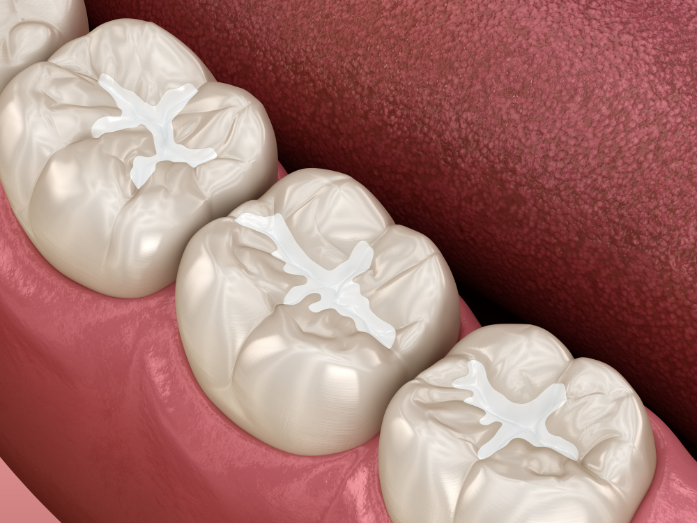 Dental Fillings: Cost and Procedures