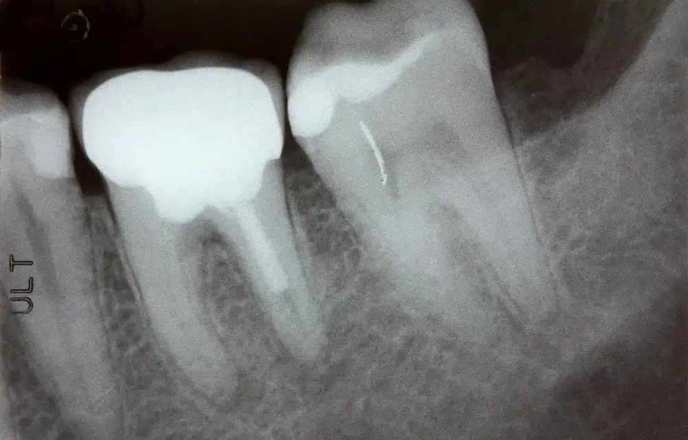 How Much is Root Canal in Australia?