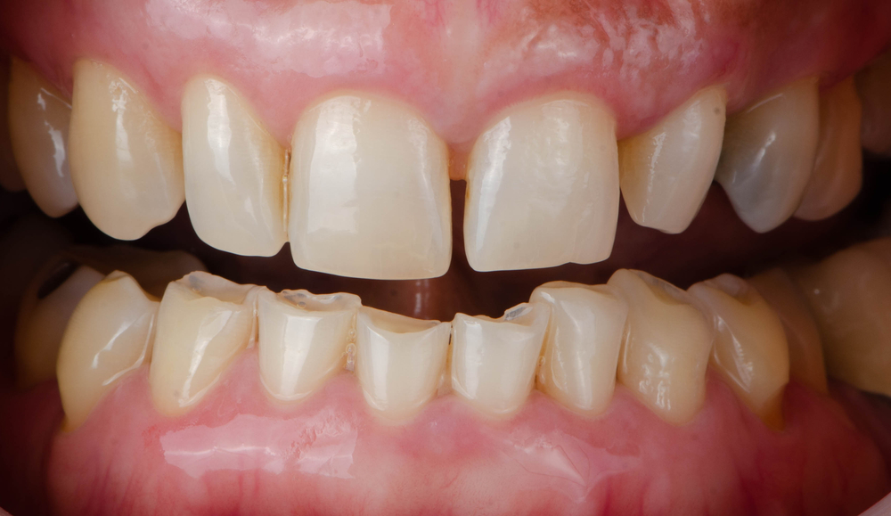 How to Fix a Chipped Tooth?