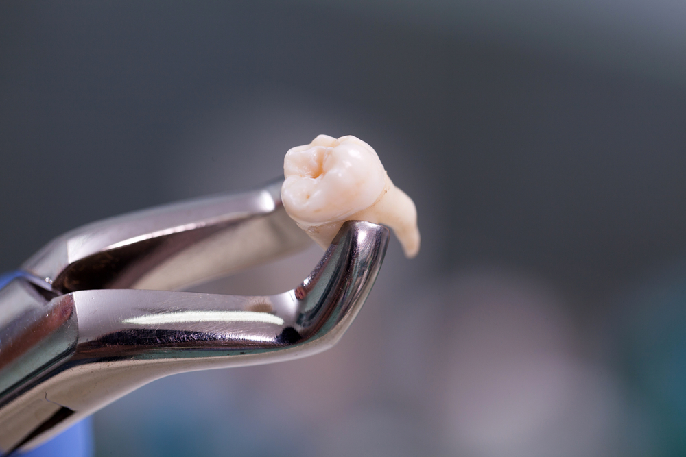 Tooth Extraction: What to Expect